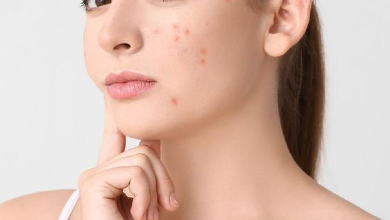 Best Facial Acne Scars Treatment in Dubai: Say Goodbye to Acne Scars